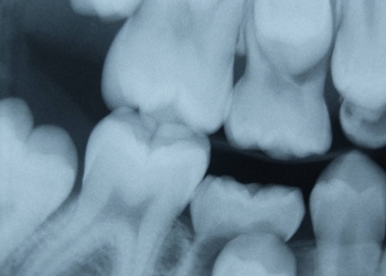 Xrays for Cheap Dental Care Opportunities